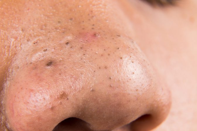 How to Remove Blackheads Naturally