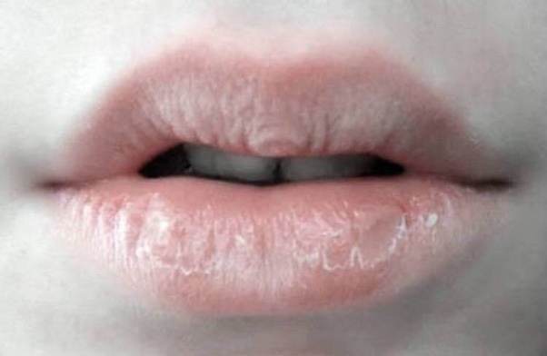 How To Get Rid Of Chapped Dry Lips Fast Overnight